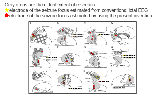 Epileptogenic domain estimation program