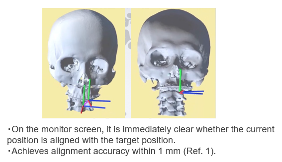 Navigation System for Orthognathic Surgery